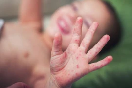 Trẻ bị tay chân miệng trở nặng do chủng vi rút nguy hiểm tái xuất 