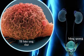 Dấu hiệu ung thư đang tấn công, dễ nhầm với bệnh thông thường