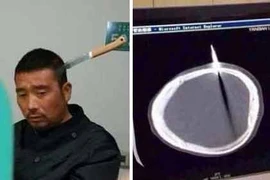 Bị dao găm vào não, vẫn bình thản đi bộ tới viện 