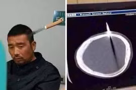 Bị dao găm vào não, vẫn bình thản đi bộ tới viện 