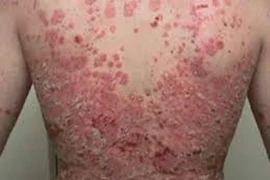 Bệnh vảy nến, viêm da cơ địa tăng do ảnh hưởng của thực phẩm