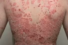 Bệnh vảy nến, viêm da cơ địa tăng do ảnh hưởng của thực phẩm