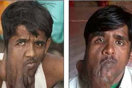 Sống ẩn dật vì khối u khổng lồ trên mặt 