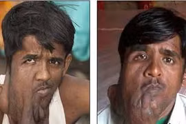 Sống ẩn dật vì khối u khổng lồ trên mặt 