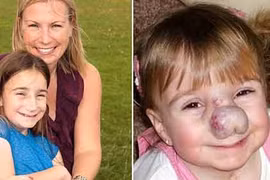 Bé gái có chiếc mũi đáng sợ vì khối u mạch máu