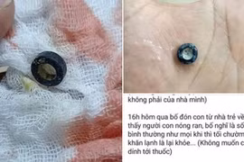 Con liên tục sốt cao sau khi đi nhà trẻ vì mắc dị vật trong mũi