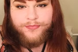 Khuôn mặt gây sốc của cô gái vài tháng không cạo râu