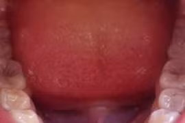 Vi khuẩn trong miệng có thể gây ung thư ruột kết