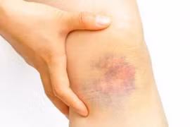 Xuất hiện những vết bầm bất thường bạn phải đến bệnh viện ngay