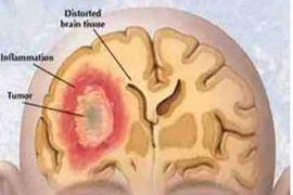 Tín hiệu cảnh báo sớm của ung thư não
