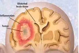 Tín hiệu cảnh báo sớm của ung thư não
