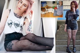 Tưởng ngồi xe lăn cả đời, cô gái đi lại bình thường nhờ đóng ghim vào chân