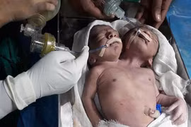 Thương tâm cặp sinh đôi hai đầu, chung một thân thể