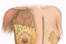 U vú lành tính hiếm khi phát triển thành ung thư