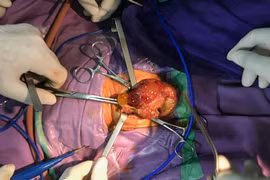 BV Sản Nhi Quảng Ninh phẫu thuật cứu sống bé sơ sinh 16 ngày tuổi 