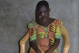 Bé mồ côi mặt biến dạng vì khối u