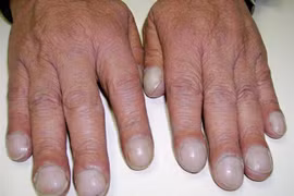 6 dấu hiệu kỳ lạ cảnh báo tim mạch có vấn đề