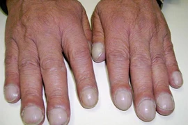 6 dấu hiệu kỳ lạ cảnh báo tim mạch có vấn đề