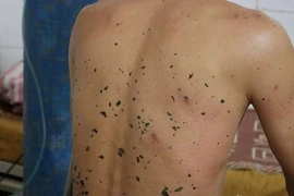 Những trường hợp ong đốt chết người thương tâm