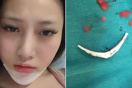 Kinh hoàng biến chứng phẫu thuật thẩm mỹ đáng sợ năm 2018