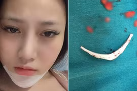 Kinh hoàng biến chứng phẫu thuật thẩm mỹ đáng sợ năm 2018