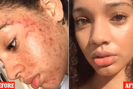 Tuyệt chiêu chữa mặt mụn chi chít sạch láng mịn chỉ trong 30 ngày