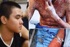Hotboy bị bệnh hiếm khiến da như bị cháy