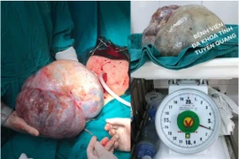 Phẫu thuật thành công khối u buồng trứng khổng lồ nặng 6,2kg