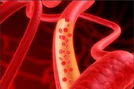 8 thực phẩm tăng cường lưu thông máu, ngăn ngừa đột quỵ