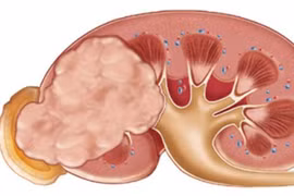 Bỏ ngay 5 thói quen này nếu không muốn chết sớm vì ung thư thận
