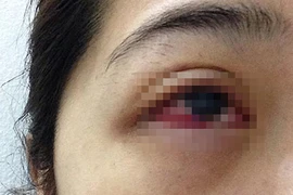 Cô gái nhiễm trùng mắt do nối mi giả 200.000 đồng