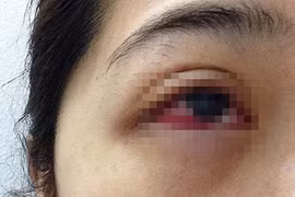 Cô gái nhiễm trùng mắt do nối mi giả 200.000 đồng