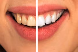 8 cách đơn giản ngừa sâu răng không cần dùng thuốc