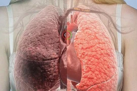 Từ trường hợp của diễn viên Mai Phương: Cách nào ngừa bệnh hiếm?