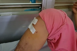 Áp lực khiến bác sĩ bệnh viện Chợ Rẫy khoan chân của bệnh nhân gãy xương ngực?