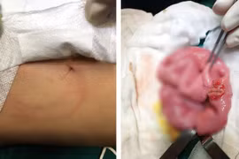 Bé 4 tuổi vỡ ruột nguy kịch do anh trai ném lon bia vào bụng