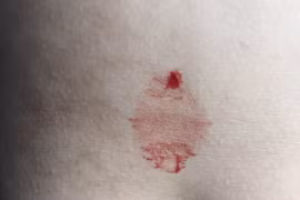 TP HCM phát hiện một trường hợp bị “mồ hôi máu” 