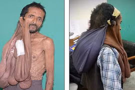 Hãi hùng khối u 11kg trên mặt chảy dài đến rốn