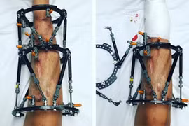 Thiếu nữ chấp nhận cưa chân để kéo dài chân vì tai nạn