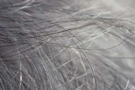 Bạc tóc tuổi đôi mươi có phải do bệnh lý?