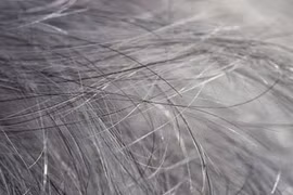 Bạc tóc tuổi đôi mươi có phải do bệnh lý?