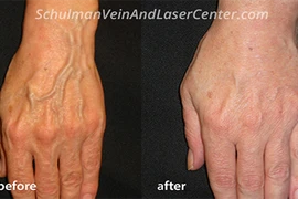 Chuyên gia chỉ những vị trí cơ thể dễ bị giãn tĩnh mạch