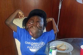 Thương tâm cậu bé “quái vật” bị khối u gây biến dạng khuôn mặt