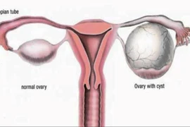 Cách nhận biết u nang buồng trứng đơn giản không ngờ
