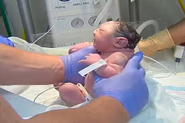 Bác sĩ lơ là, mẹ sinh con đầu nhỏ do nhiễm Zika