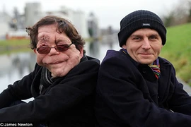 Cặp sinh đôi người dị dạng người mắc bệnh quái ác