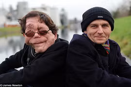 Cặp sinh đôi người dị dạng người mắc bệnh quái ác