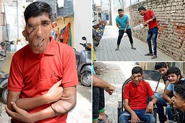 Khối u đáng sợ biến khuôn mặt trai trẻ thành mặt voi