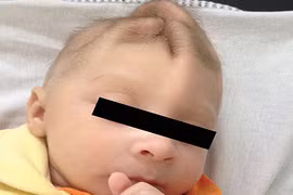 Sự tàn phá khủng khiếp của virus Zika tới não thai nhi