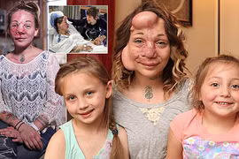 Hy hữu bà mẹ sống sót nhờ cấy túi nước biển vào mặt